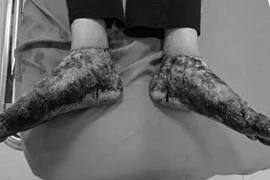 Tự ý ngâm chân bằng nước lá đun nóng, người bệnh bị bỏng nặng hai bàn chân