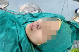 Mổ lần 3 tìm lại nụ cười cho hai chị em bị dị tật khe hở môi mũi bẩm sinh