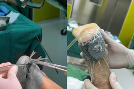 Cứu giữ gót chân dập nát cho người bệnh đa chấn thương 