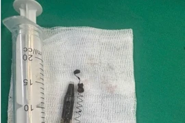 Lấy dị vật tồn tại trong thái dương 13 năm gây đau kéo dài