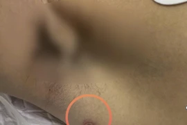 Sốt cao tự điều trị, người đàn ông suy đa tạng nguy kịch 