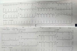 Phối hợp liên viện cấp cứu rối loạn nhịp tim nguy kịch bằng công nghệ cao