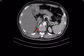 Tiểu khó đi khám người đàn ông phát hiện mắc đồng thời hai loại ung thư