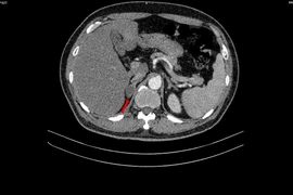Tiểu khó đi khám người đàn ông phát hiện mắc đồng thời hai loại ung thư