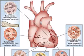 Điều trị suy tim ở bệnh nhân 34 tuổi bằng liệu pháp tế bào gốc tự thân 