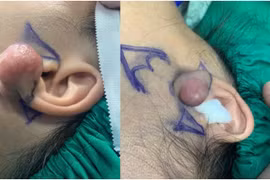 Cô gái 32 tuổi chán nản mất tự tin vì u xơ vành tai lớn tái phát 6 lần