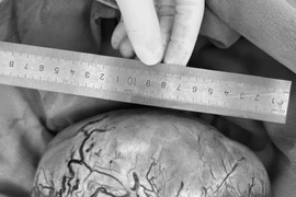 Bụng to bất thường, phát hiện ung thư tinh hoàn kích thước lớn trong ổ bụng