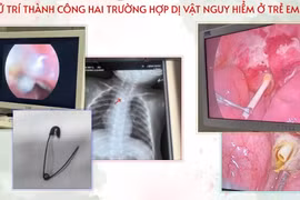 Ho sốt kéo dài ở trẻ 7 tháng do dị vật kim ghim bùa bình an trong cơ thể