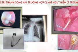 Ho sốt kéo dài ở trẻ 7 tháng do dị vật kim ghim bùa bình an trong cơ thể