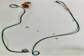 Đau lưng, sốt, tiểu đục người phụ nữ 29 tuổi không ngờ bỏ quên rút thông JJ