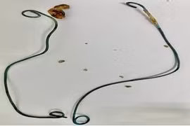 Đau lưng, sốt, tiểu đục người phụ nữ 29 tuổi không ngờ bỏ quên rút thông JJ