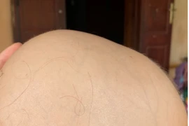 Điều trị thành công ca rụng tóc toàn bộ da đầu cho bệnh nhi 7 tuổi