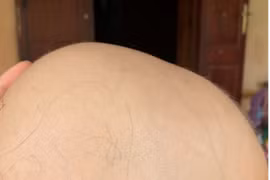 Điều trị thành công ca rụng tóc toàn bộ da đầu cho bệnh nhi 7 tuổi