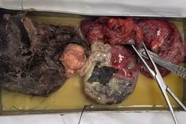 U quái buồng trứng 15 cm vỡ rơi răng và tóc trong bụng bệnh nhân