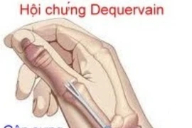 Chữa viêm gân cổ tay sớm tránh bệnh lý nguy hiểm cơ xương khớp