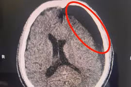 Ngã xe “tưởng nhẹ”, sau 2 tháng mới đau đầu, hôn mê