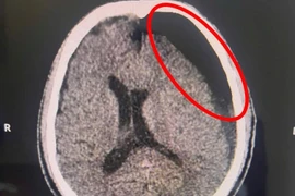 Ngã xe “tưởng nhẹ”, sau 2 tháng mới đau đầu, hôn mê