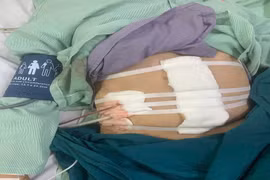 Giành lại sự sống cho bệnh nhân gần 100 tuổi bị thủng hang vị dạ dày