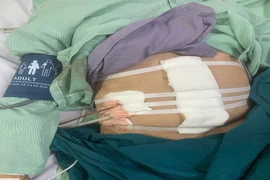 Giành lại sự sống cho bệnh nhân gần 100 tuổi bị thủng hang vị dạ dày