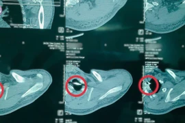 Hy hữu, đinh Kirschner gãy, di trú vào phổi sau phẫu thuật vai