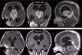 Lấy u não 6 cm ở trẻ 7 tháng tuổi, hồi sinh sự sống