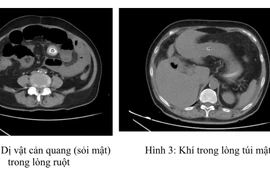 Tắc ruột do sỏi túi mật, “quả bom nổ chậm” ít ai ngờ