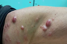 Chủ quan sẩn cục bất thường ở da, không ngờ u ác tính