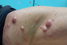 Chủ quan sẩn cục bất thường ở da, không ngờ u ác tính