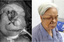 Lấy u khổng lồ vùng mặt cho cụ bà 96 tuổi