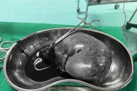 Cứu thai phụ 28 tuần bị u nang buồng trứng xoắn hoại tử 