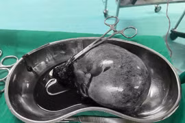 Cứu thai phụ 28 tuần bị u nang buồng trứng xoắn hoại tử 