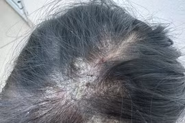 Áp xe mủ da đầu, rụng tóc do nấm Kerion, cách phòng tránh?