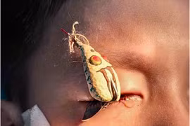 Hai trẻ chấn thương mắt nặng vì móc câu ghim vào mắt