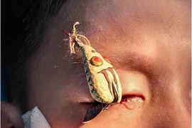 Hai trẻ chấn thương mắt nặng vì móc câu ghim vào mắt