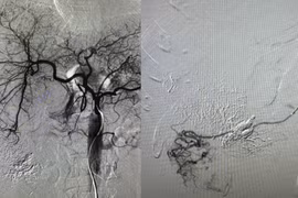 Đang trẻ khỏe bất ngờ vỡ u gan do ung thư