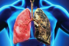 Việt Nam lọt nhóm 15 quốc gia có tỷ lệ nam giới hút thuốc cao nhất thế giới