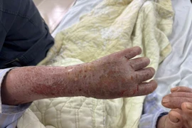 Bôi thuốc lá để chữa ngứa, cụ bà 61 tuổi nhập viện da bong vảy khắp người