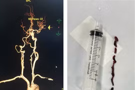 Phối hợp liên tuyến cứu cụ bà đột quỵ tại bệnh viện kịp thời 