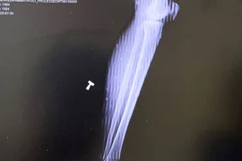 Ăn uống thiếu vệ sinh, nhiều người nhiễm ký sinh trùng nhập viện điều trị