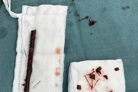 Ngã xuống ao, trẻ 3 tuổi bị cành cây đâm xuyên trực tràng, ruột non 4 tháng