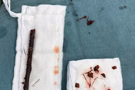 Ngã xuống ao, trẻ 3 tuổi bị cành cây đâm xuyên trực tràng, ruột non 4 tháng