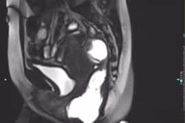 Tiêm búi trĩ không đau người bệnh 35 tuổi biến chứng nặng nề