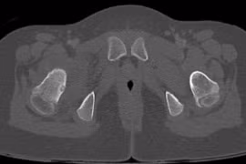 Cứu đôi chân cho bệnh nhi 7 tuổi bị u xương hiếm gặp
