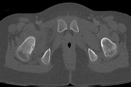 Cứu đôi chân cho bệnh nhi 7 tuổi bị u xương hiếm gặp