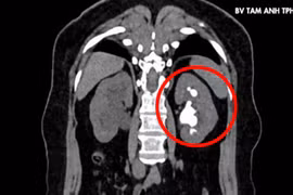 Lấy sỏi san hồ lấp đầy đài bể thận cho người phụ nữ 51 tuổi