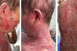 Người phụ nữ 35 tuổi bọng nước toàn thân vì tắm lá