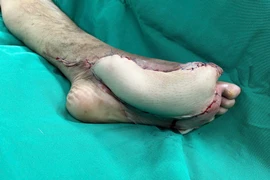 Giữ lại bàn chân đang hoại tử cho bệnh nhân đái tháo đường