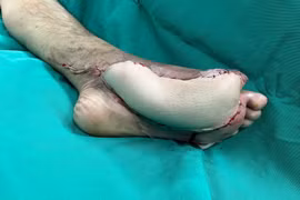 Giữ lại bàn chân đang hoại tử cho bệnh nhân đái tháo đường