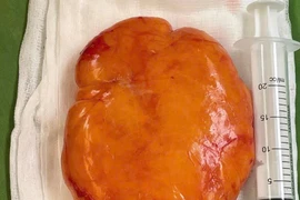 Giúp người phụ nữ thoát khỏi khối u mỡ khổng lồ ở lưng