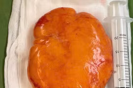 Giúp người phụ nữ thoát khỏi khối u mỡ khổng lồ ở lưng